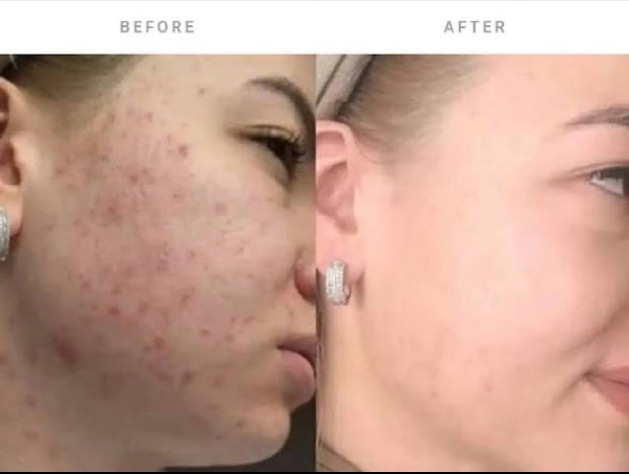 Collagen Remodelling Scar Treatment